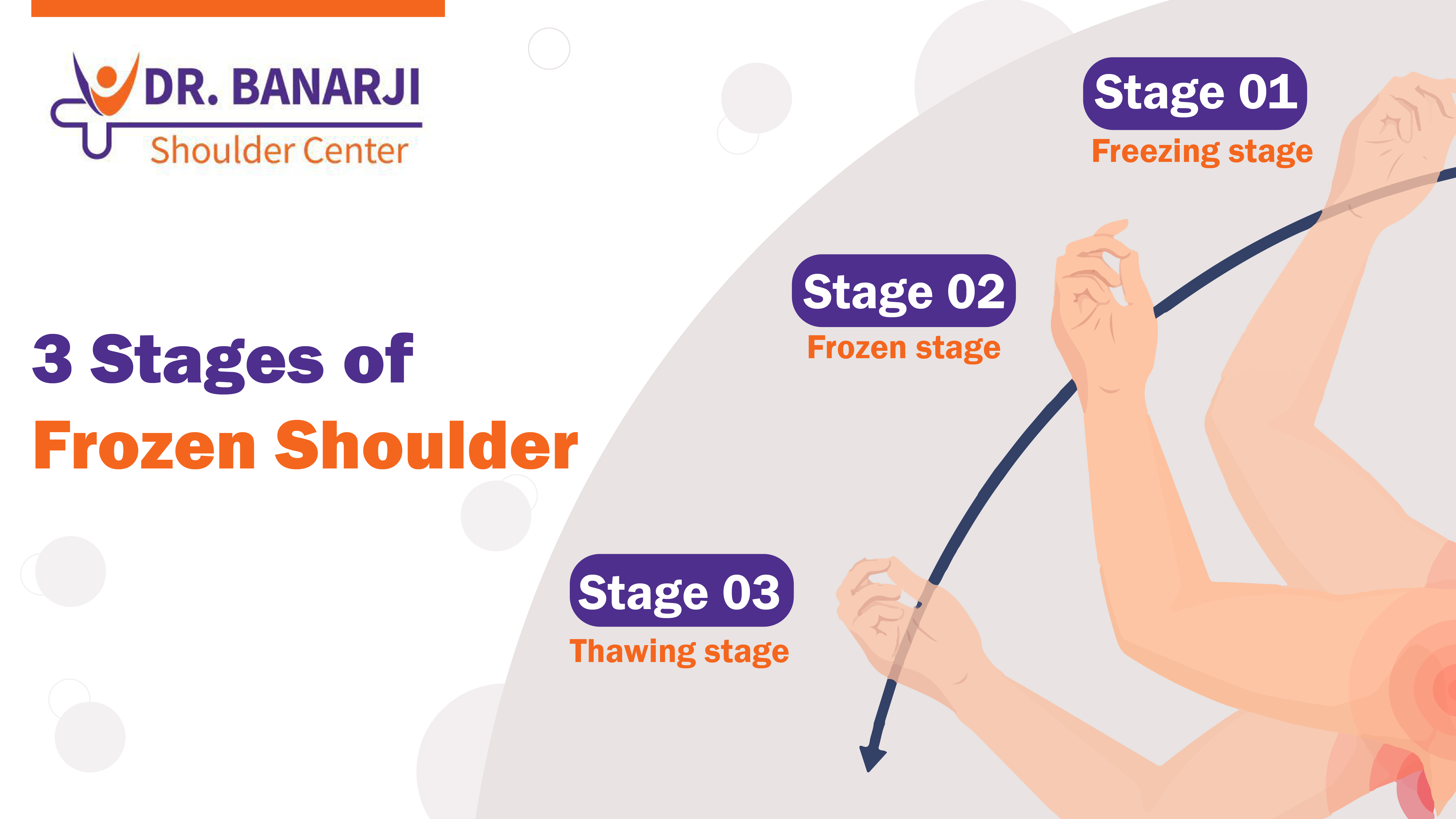 4 Stages Of Frozen Shoulder: Average 12-18 Month Progression Revealed