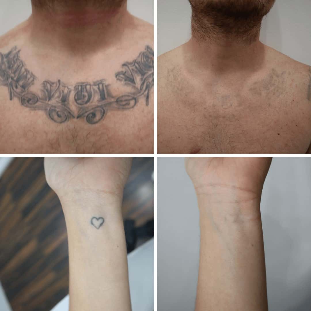 Average Cost Of Tattoo Removal Bronctattooaus Com