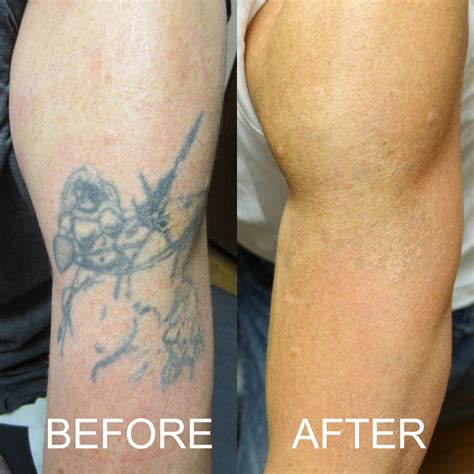 Before And After Tattoo Removal