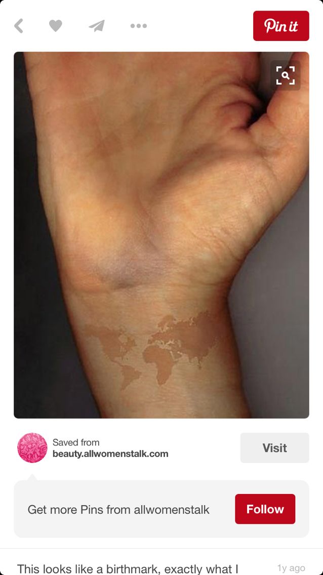 Birthmark Cover Up Smiley Face Tattoo Located On The Birthmark Cover Up Smiley Face Tattoo Located On The