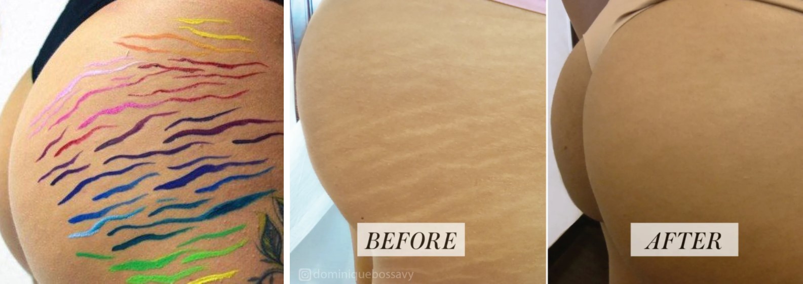 Can You Tattoo Over Stretch Marks How To Conceal Or Cover Stretch