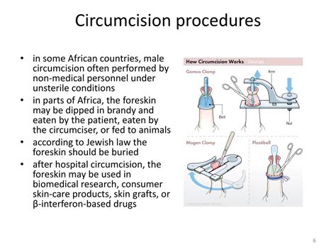 Different Types Of Circumcision Procedures At Will Hannah Blog Different Types Of Circumcision Procedures At Will Hannah Blog