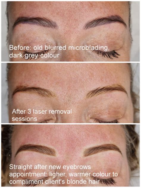 How To Remove An Eyebrow Tattoo Microblading Or Laser Micro How To Remove An Eyebrow Tattoo Microblading Or Laser Micro