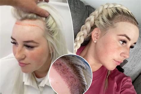 I Spent Over 6K On A Hair Transplant And People Are Shocked