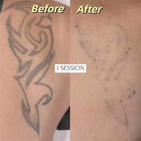 Laser Tattoo Removal Before Amp After Laser Tattoo Removal Before Amp After