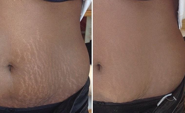 Tattooing Over Stretch Marks Before And After