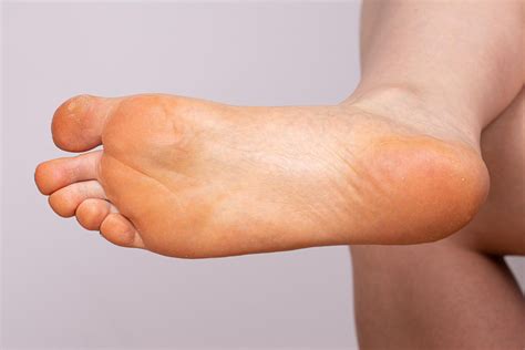 Yellow Feet 6 Potential Causes